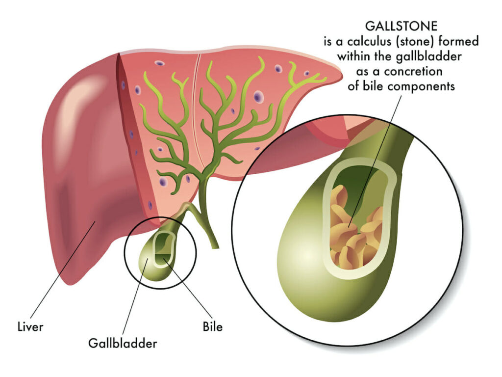 Gallbladder liver stones illus