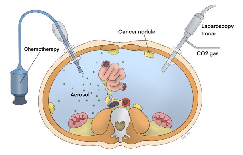 PIPAC (Pressurized IntraPeritoneal Aerosol Chemotherapy): Επιστημονική Προσέγγιση