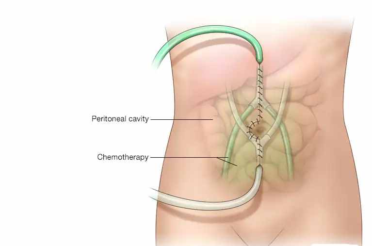 heated intraperitoneal chemotherapy 3941527