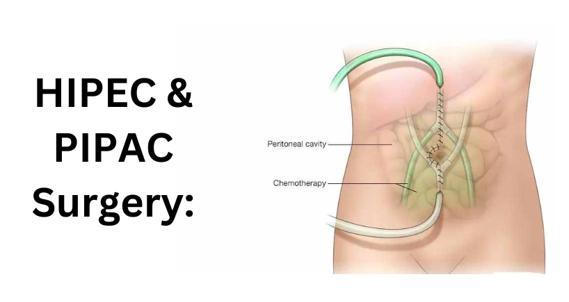 HIPEC PIPAC Surgery1