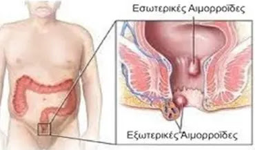 ΑΙΜΟΡΡΟΙΔΕΣ (Hemorrhoids) 1