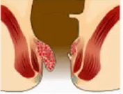 aimorroides_4ou-vathmou ΑΙΜΟΡΡΟΙΔΕΣ (Hemorrhoids) 4ου βαθμού