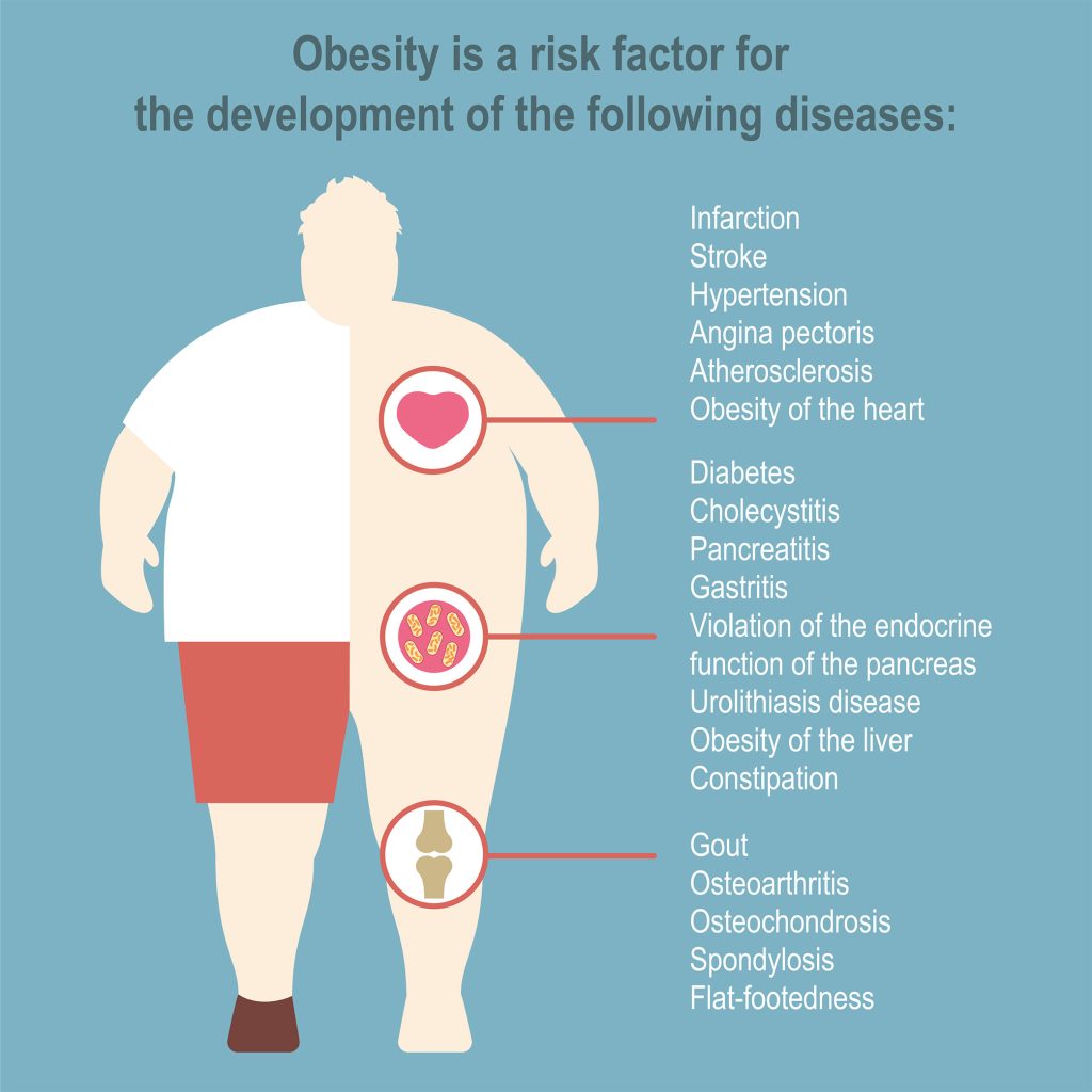 obesity-risk-factors Απόστολος Ράπτης - Γενικός Χειρουργός