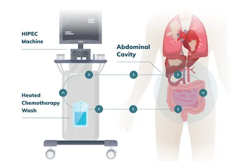 HIPEC (Hyperthermic Intraperitoneal Chemotherapy)