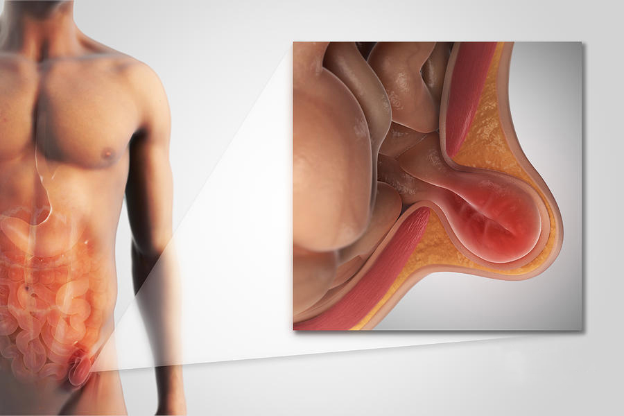 1-inguinal-hernia-science-picture-co Κήλη - Hernia